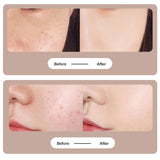 Tattoo Mole Removal Plasma Pen, Laser Facial Freckle Dark Spot Remover Tool, Wart Removal Machine, Face Skin Care Beauty Device