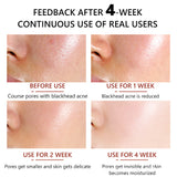 30ml Cleansing Pore, Salicylic Acid
