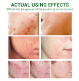 Acne Treatment Serum, Facial Skin Repair Oil