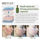Breylee Acne Treatment Serum, Face Facial Anti Acne Scar Removal Cream, Whitening Skin Repair Pimple Remover Formula