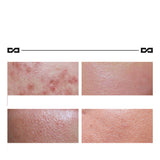 Herbal Lightening Acne Cream, Skin Care