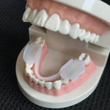 Braces to Prevent Molars