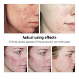 Breylee Acne Treatment Serum, Face Facial Anti Acne Scar Removal Cream, Whitening Skin Repair Pimple Remover Formula
