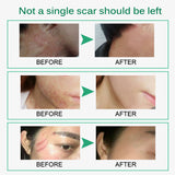Skin Rebound Scarless Cream, Scar Removal Face Gel for Face Acne Scar Stretch Marks, Skin Repair Formula
