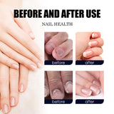 Hand and Foot Soft Nail Thickening Care Solution (Pack of 2)
