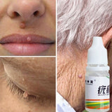 Skin Marking, Mole and Wart Remover (Pack of 2)
