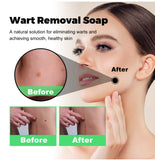 Skin Cleansing Soap for Wart-prone & Spot Areas