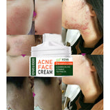Easy to use and Effective Acne Cream
