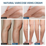 Leg Massage, Relieve Foot Earthworm, Leg Veins Swelling Cream (Pack of 2)