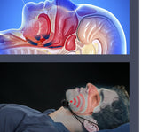 Intelligent Anti-snoring, Apnea-aid Magic Device