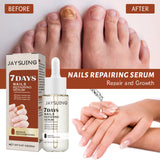 Thickening Nail Repair Serum for Hands and Feet – Improves Onychomycosis